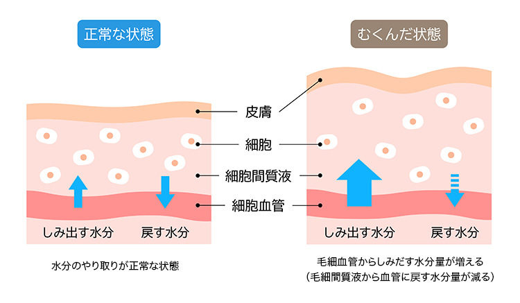 浮腫のしくみイラスト