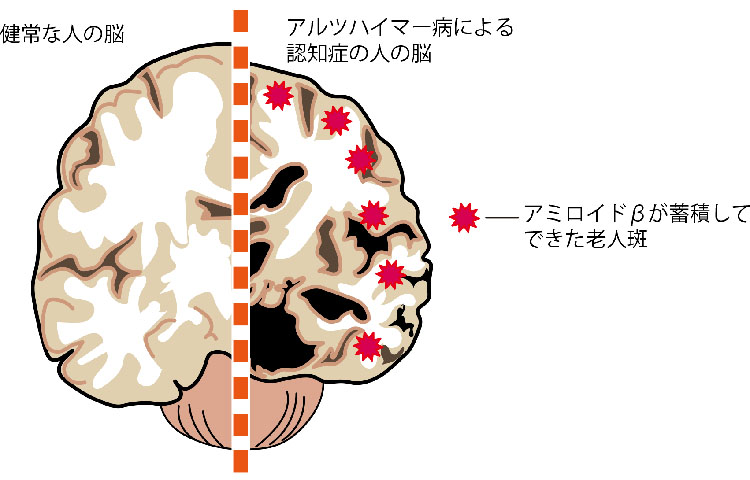 図：健常な人の脳とアルツハイマー病による認知症の人の脳の比較