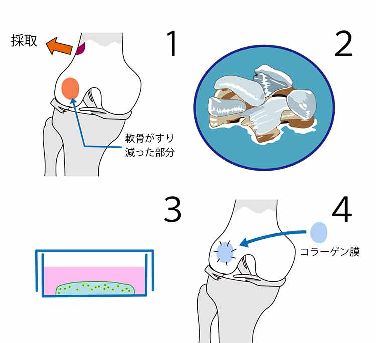 図:「自家培養軟骨」を用いた変形性膝関節症の治療の流れ