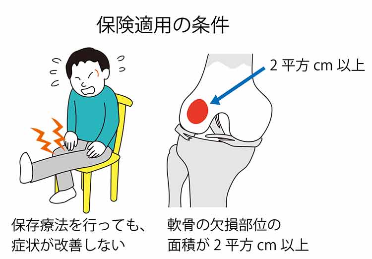 図:保険適用の条件。保存療法を行っても症状が改善しない。軟骨の欠損部位の面積が2平方センチメートル以上