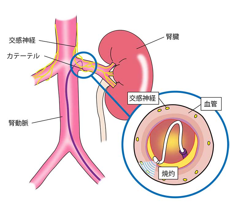 腎デナベーションの手順イラスト図