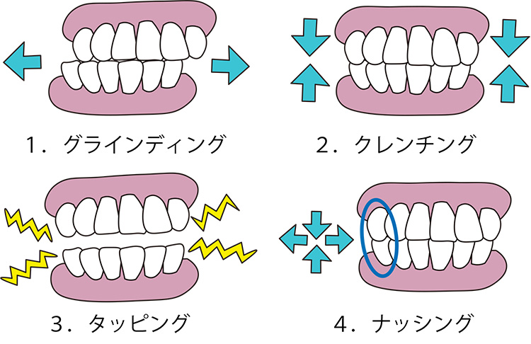 イラスト：歯ぎしりはグライディング、クレンチング、タッピング、ナッシングの4つのタイプに大別される。