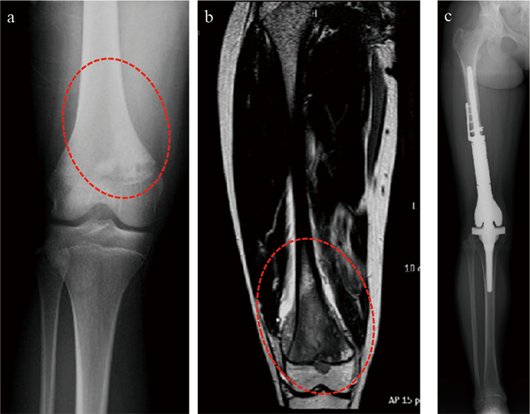 骨肉腫およびユーイング肉腫の放射線科