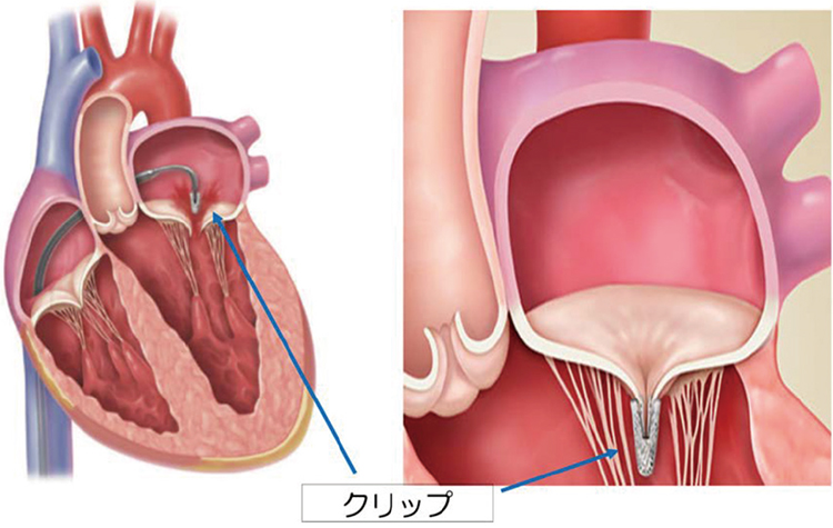 カテーテルで心臓病を治す。体に負担の少ない手術 | 病気と治療の検索サイト「メディカルブレイン」