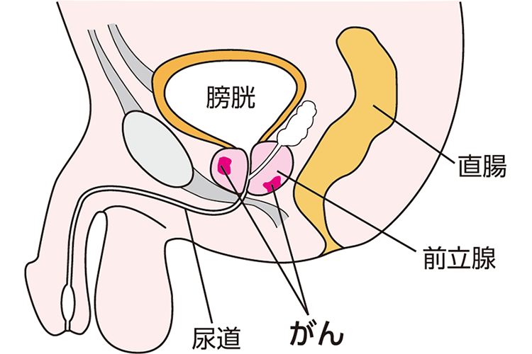 尿道 イヤホン 人気