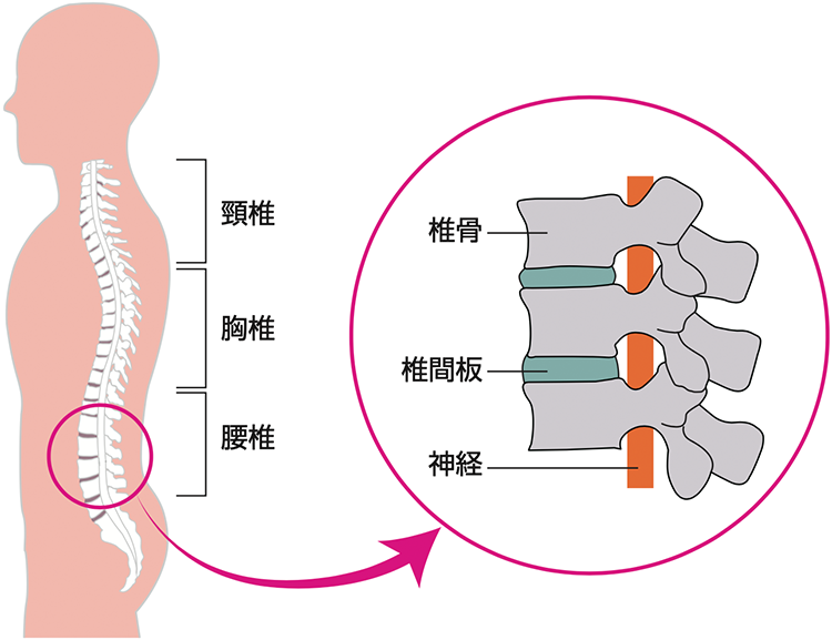 腰椎椎間板ヘルニアに対する新規治療の開発 | 病気と治療の検索サイト「メディカルブレイン」