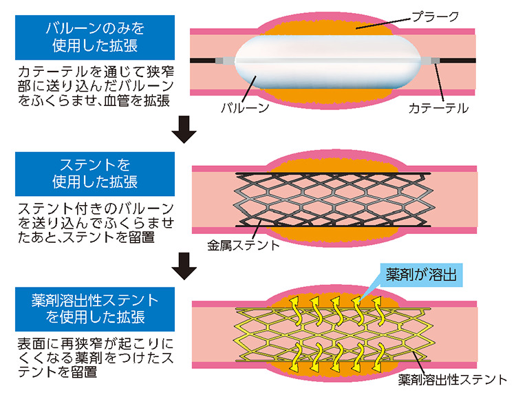 心臓血管形成術とステント留置術の準備はどのようにすればよいですか?