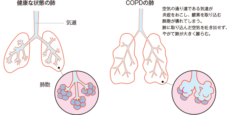 「慢性疾患」は法的にどのように定義されますか?